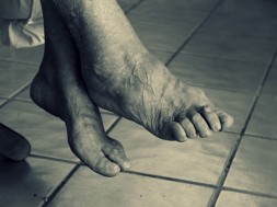 ostroga piętowa stopy leczenie